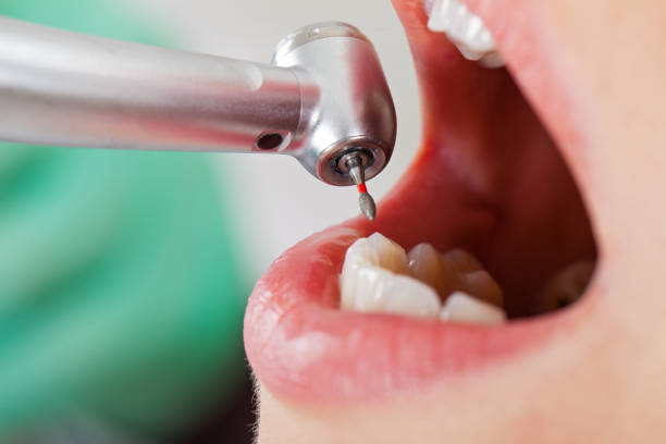 Best Lost Filling or Crown Replacement in Purvis, MS